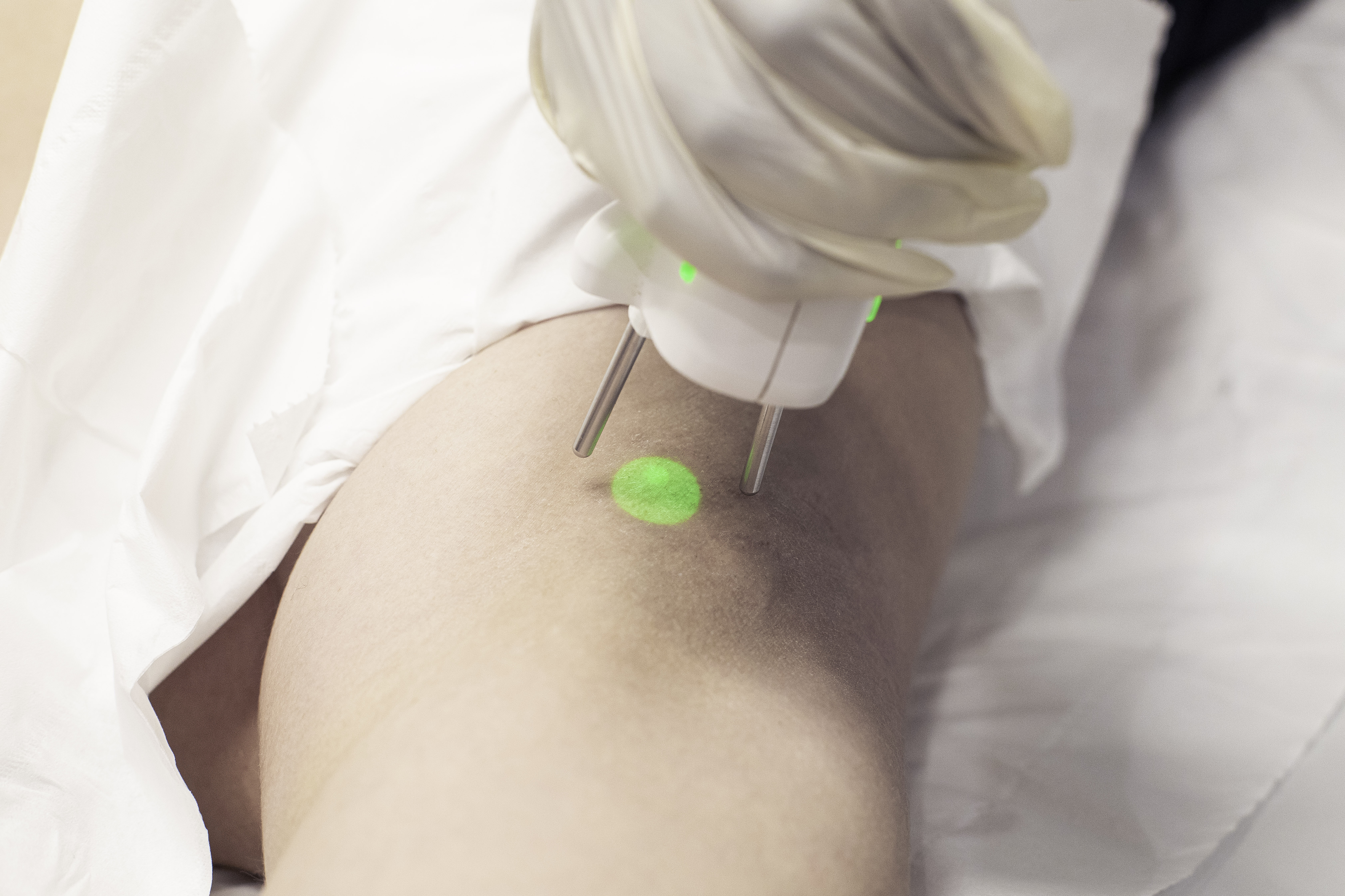 epilation-laser.jpg