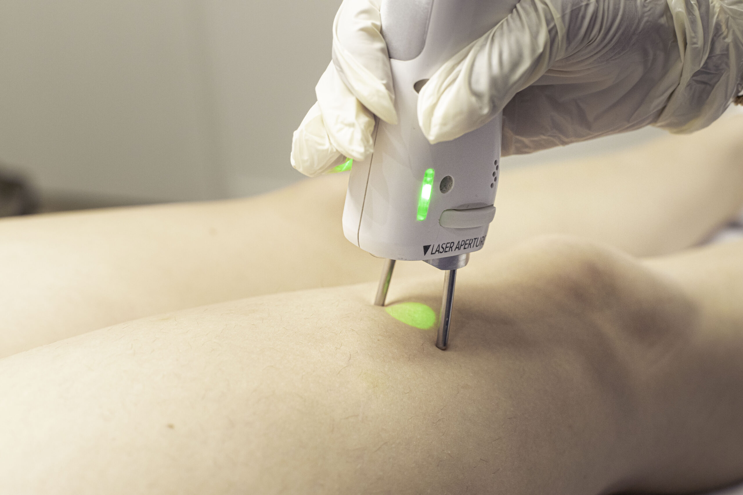 Séance d’épilation laser des jambes à l’Institut Lazeris