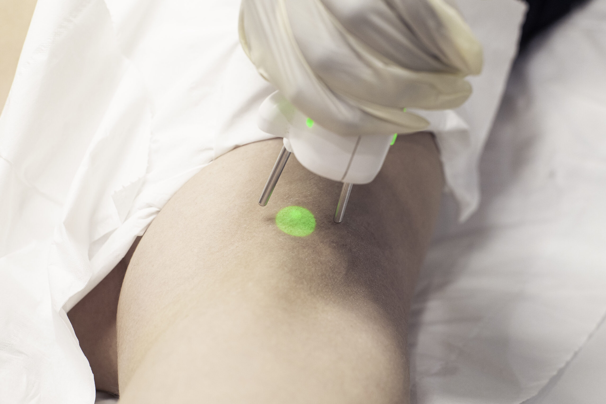 Traitement laser de la zone du maillot à l’Institut Lazeris
